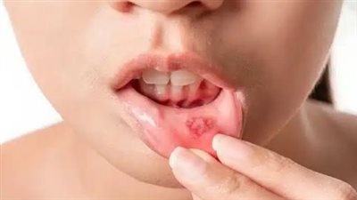 لغز سرطان الفم والأمعاء: هل هي ضريبة المواد الكيميائية 