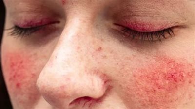 الذئبة الحمراء: كل ما تحتاج لمعرفته عن أعراضها وطرق تشخيصها