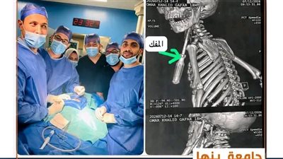 معجزة طبية في بنها.. إنقاذ طفل عمره عام ونصف من إصابة نافذة بالرقبة