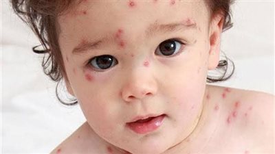 الجدرى المائى للأطفال.. نصائح للأم لاكتشافه وطرق علاجه