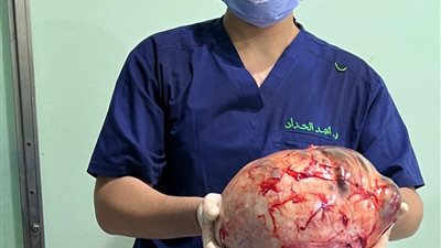 إزالة ورم بحجم 10 كجم من رحم سيدة 