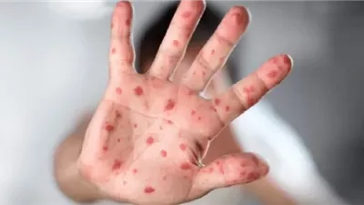 الكونغو الديمقراطية تحصل على 100 ألف جرعة لقاح لجدري القردة من فرنسا