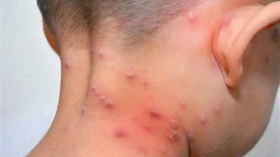سلالة جديدة من جدري القرود تضرب العالم.. اللقاح لايحمى من الأصابه به