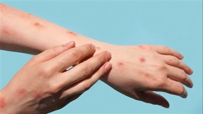 غانا تسجل أول حالة وفاة بفيروس جدري القردة