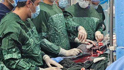 إجراء قسطرة معقدة بإستخدام جهاز الإيكمو بمعهد القلب القومي