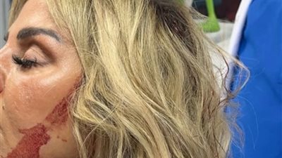 رزان مغربي تُجري عملية جراحية بعد سقوط سقف قاعة حفلة عليها