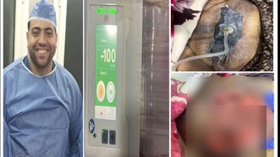 دمياط العام تنقذ حياة سيدة سبعينية من البكتيريا آكلة اللحم بجهاز الـ Vacuum مجاناً